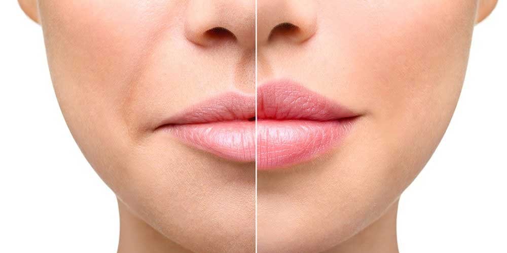 Derm Fillers