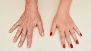 Hand Rejuvenation