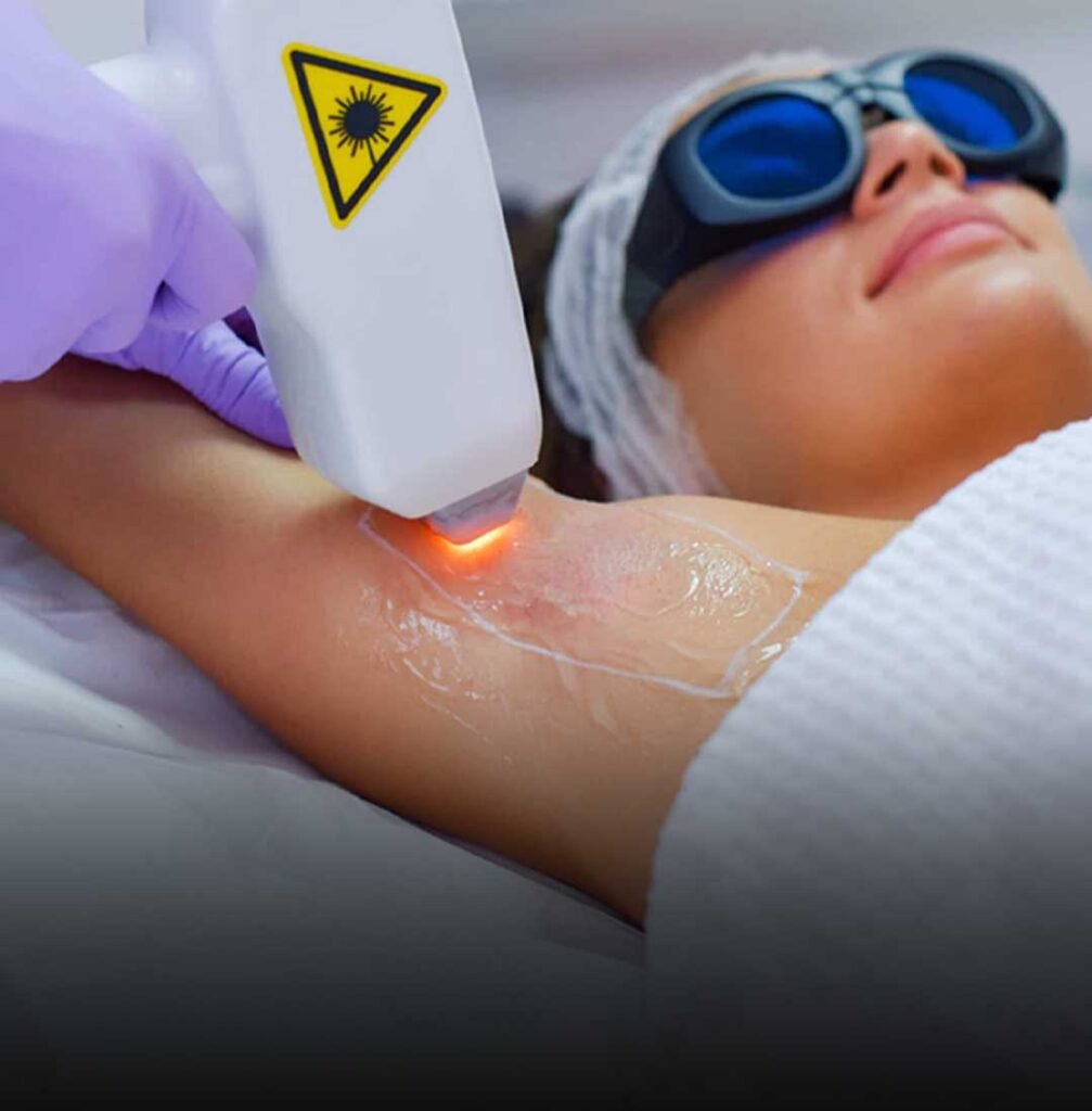 Laser-Hair-Removal
