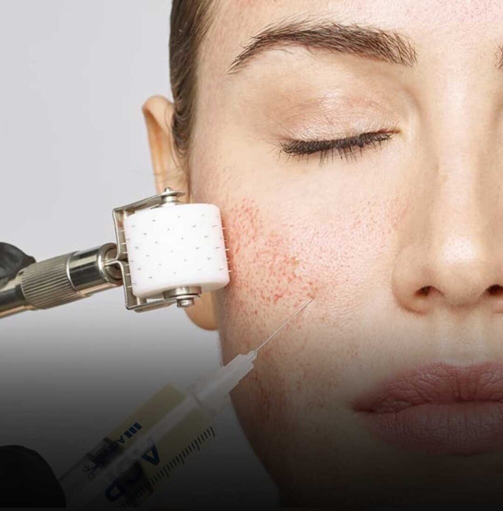 PRP (Non-Surgical Facelift)
