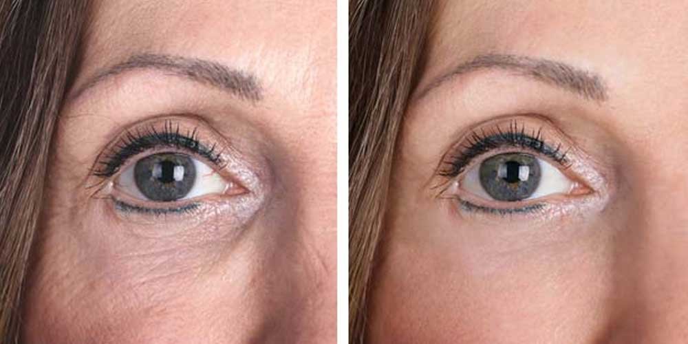 PRP (Non-Surgical Facelift)