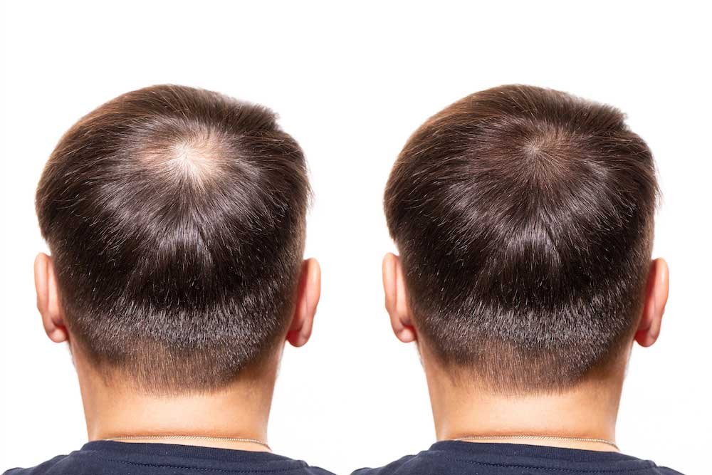PRP for Hair Restoration