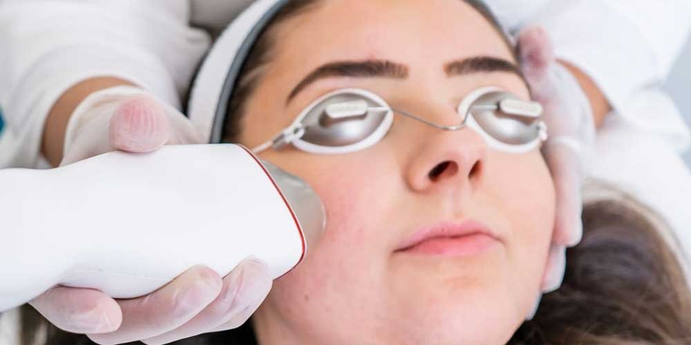 RFN (Radio Frequency) Micro-Needling Laser