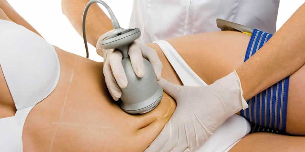 Radio Frequency Body Sculpting