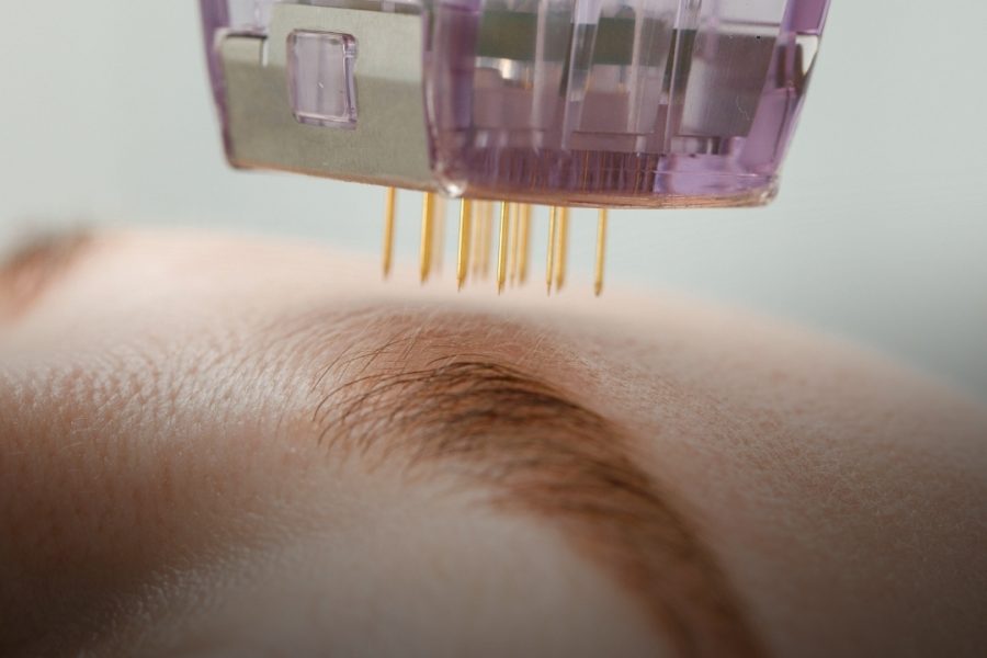 RFN Micro-Needling